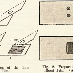 Preparation of Blood Film, Indian Medical Gazette, 1931