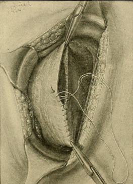 illustration of a cesarean section