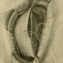 illustration of a cesarean section